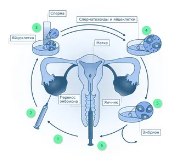 Аутотранплантация коркового слоя яичников после активации IN VITRO для лечения бесплодия :сокращенная процедура
