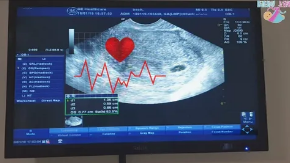 Глубокое обучениекак инструмент прогнозирования сердцебиения плода при беременности после культивирования в системе TIME-LAPSE и переноса бластоциты